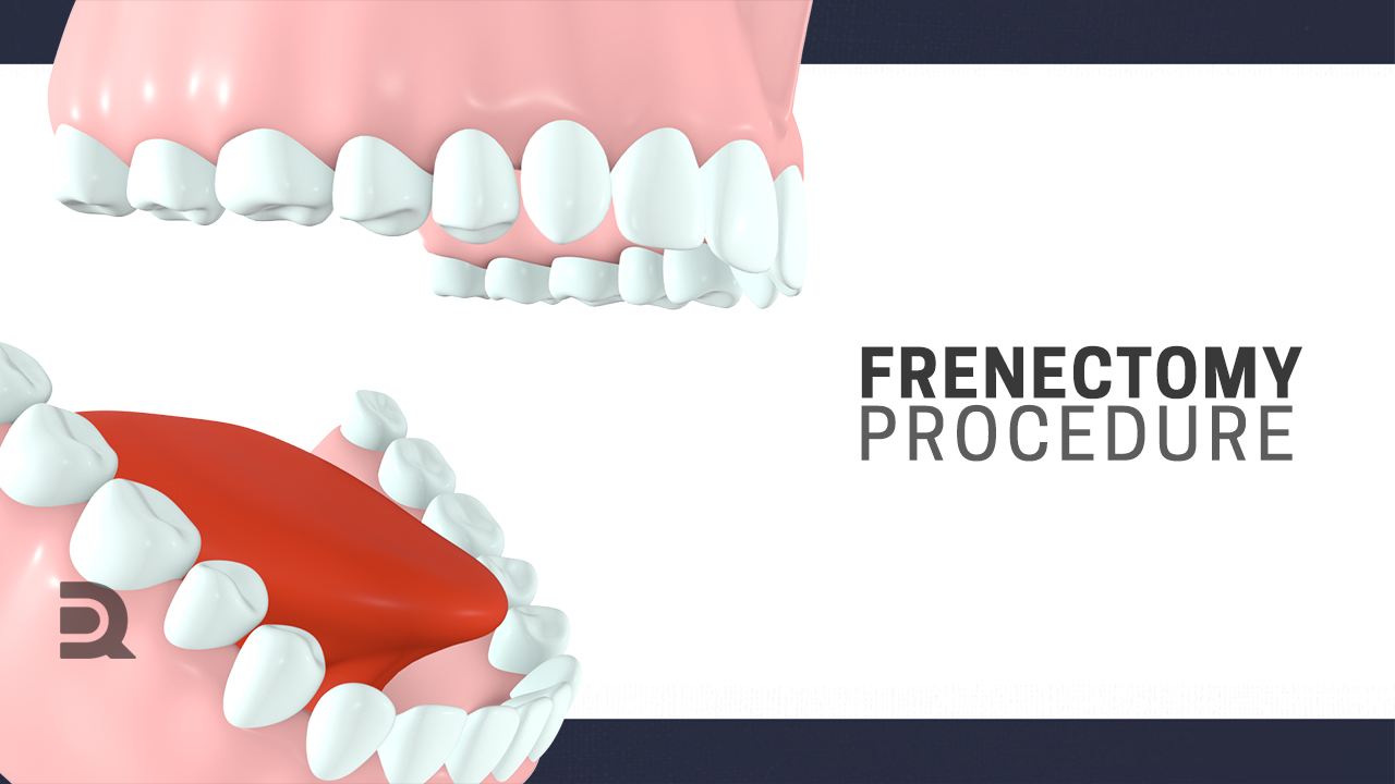 Frenectomy – Joseph Barclay, image size:1280x720