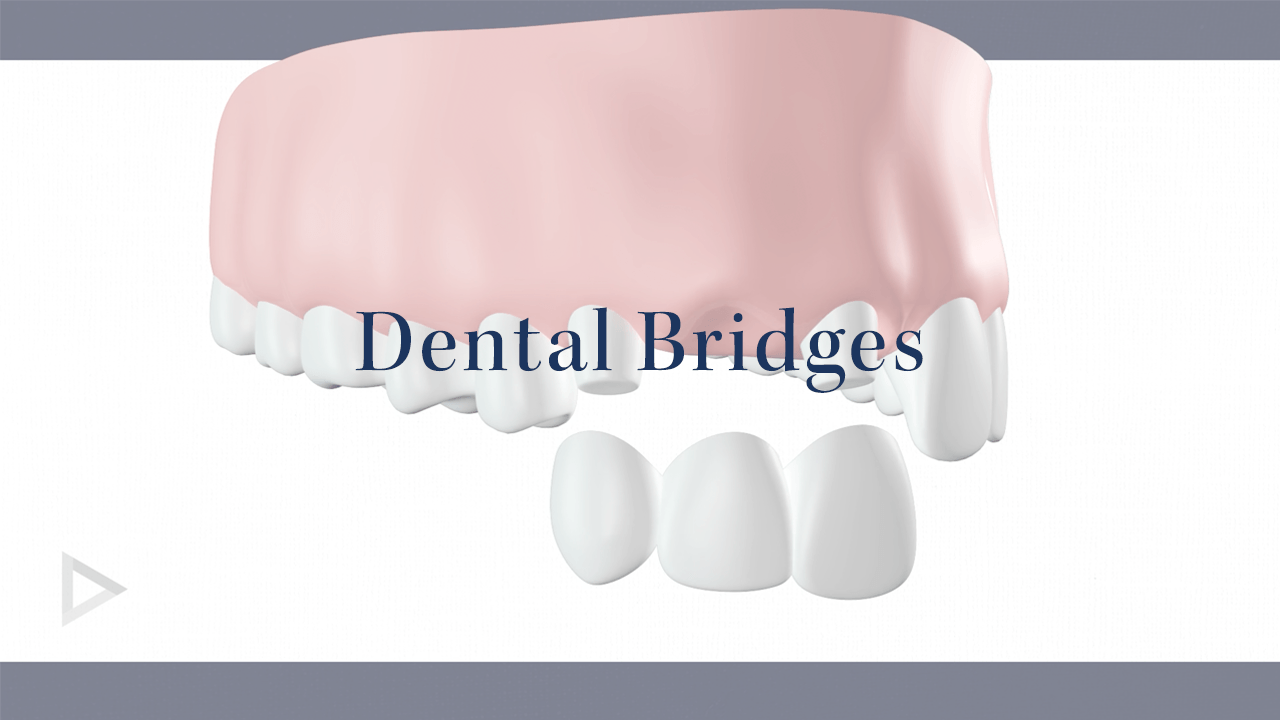 Dental Bridges  Dentist in Naples, FL